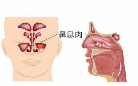 鼻窦炎可以通过手术治好吗
