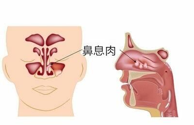 鼻窦炎可以通过手术治好吗图1