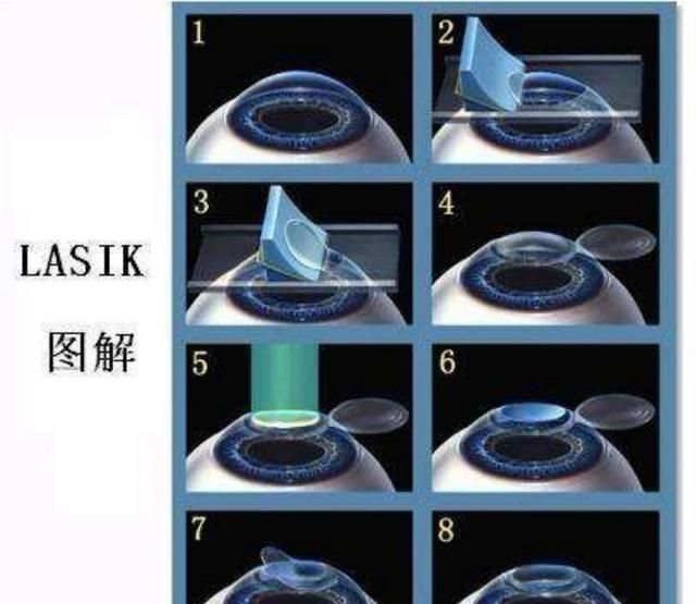 激光手术真的无后遗症,激光眼手术有后遗症吗图1
