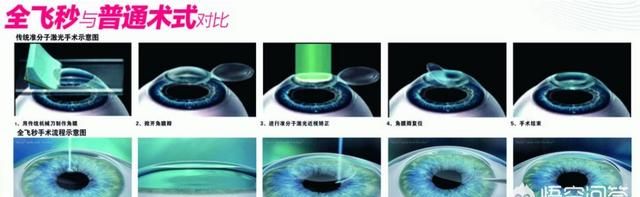 激光手术真的无后遗症,激光眼手术有后遗症吗图2