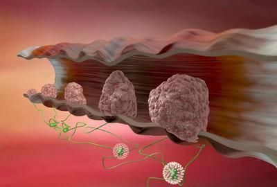 结肠癌形成要几年,结肠癌最快形成需要几年图4