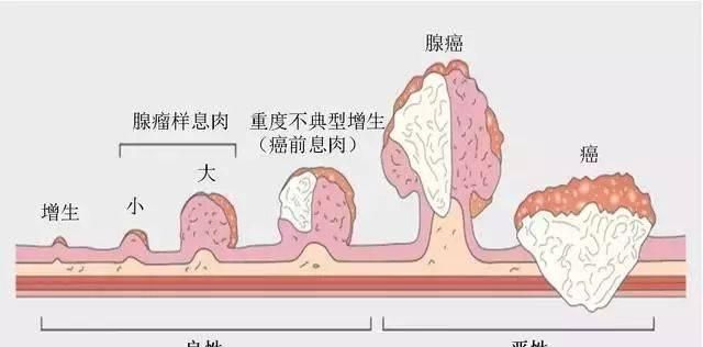 结肠癌形成要几年,结肠癌最快形成需要几年图5