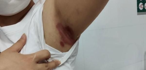 跳了一周“刘畊宏健身操”后，长沙妹子腋窝皮肤开始溃烂，痛痒难忍
