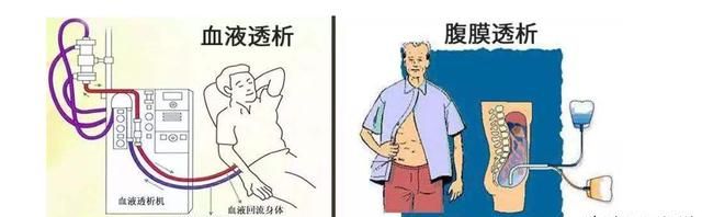 肾衰竭病人做了透析还能活多久图2