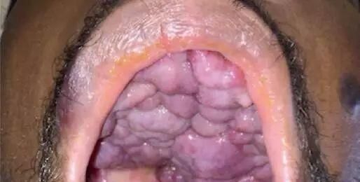 艾滋病患者一定要重视的肿瘤——卡波西肉瘤
