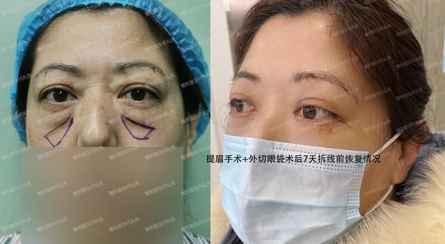 女性40岁以后还想年轻，眼周抗衰老，离不开的三个医美项目