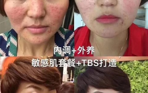 醋和蜂蜜有什么护肤功效