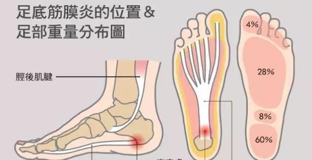 “脚跟疼”的足底筋膜炎，中医是如何看待的
