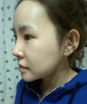 整容消除颧骨和下颚骨图6
