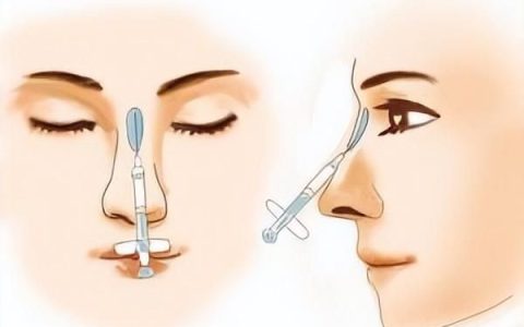 为什么玻尿酸隆鼻会这么受欢迎(玻尿酸隆鼻的全过程)