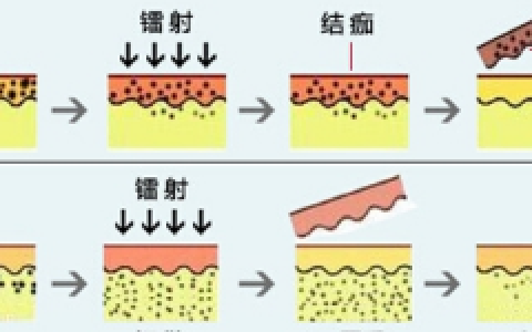 激光祛斑会不会反弹比以前更严重了