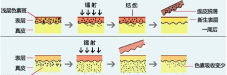 激光祛斑后会不会反弹，激光祛斑后悔死了想想都可怕！