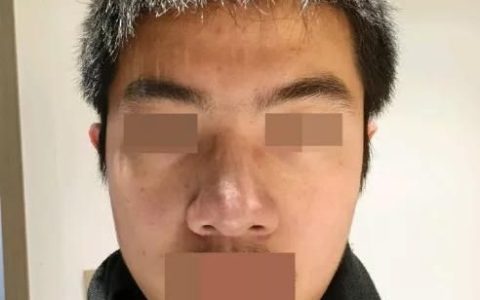 过大且臃肿的鼻子应该如何改善