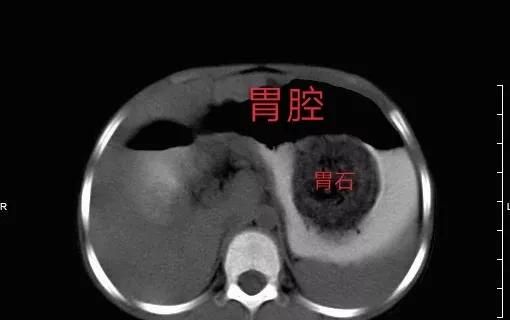 吃山楂注意什么,吃山楂时有哪些禁忌图7