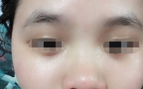 鼻子有点塌而且鼻梁又不高怎么办
