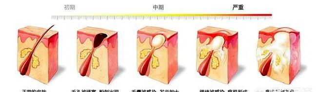 下巴长痘痘怎么处理(下巴长了痘痘怎么处理)图4