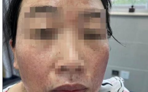 药水祛黄褐斑多长时间痂会自己掉