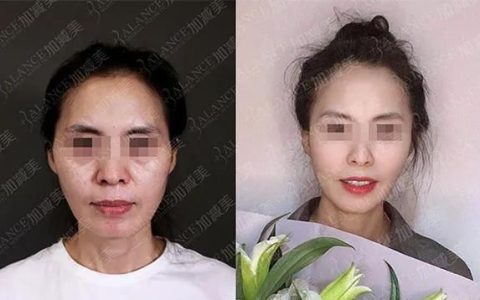 面部提升的价格是多少,面部提升手术大概价格