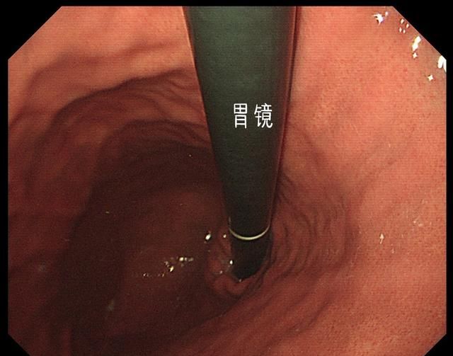 你会看胃镜报告吗？可能你一直都看错了！