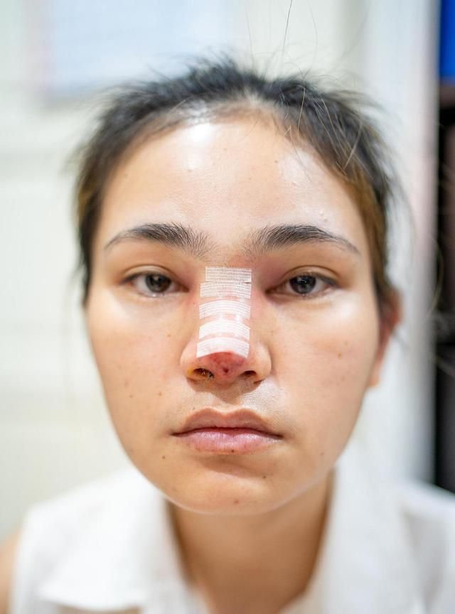 为什么做了硅胶隆鼻多年，竟莫名其妙穿出了？进来了解一下