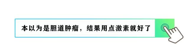 本以为是癌症，结果用点激素就好了——免疫球蛋白G4相关性胆管炎