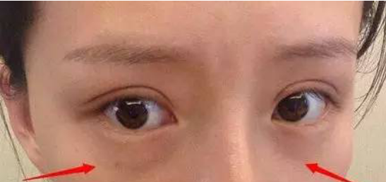 医生不会说的 | 眼袋出现了就必须手术么？