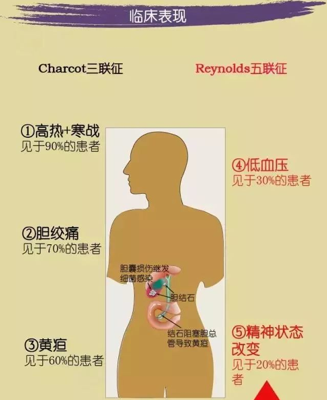 什么是Murphy征、Charcot三联征？谈胆囊炎与胆管炎的典型症状