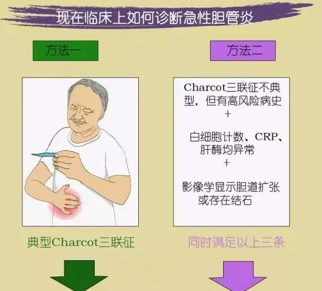 什么是Murphy征、Charcot三联征？谈胆囊炎与胆管炎的典型症状