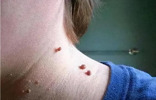 脖子和腋下的“小肉粒”是什么？可以直接用手揪掉吗？告诉你答案