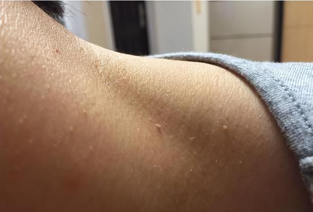 脖子和腋下的“小肉粒”是什么？可以直接用手揪掉吗？告诉你答案