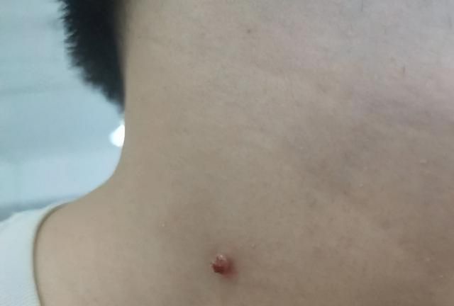 脖子和腋下的“小肉粒”是什么？可以直接用手揪掉吗？告诉你答案