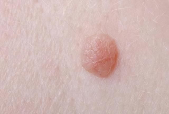 脖子和腋下的“小肉粒”是什么？可以直接用手揪掉吗？告诉你答案