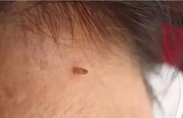 脖子和腋下的“小肉粒”是什么？可以直接用手揪掉吗？告诉你答案