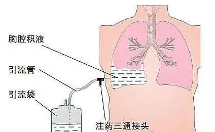 护士必看：胸腔闭式引流护理，这些细节不容小觑