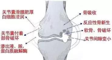 治疗骨刺最好的方法(膝盖骨刺的治疗方法)图6