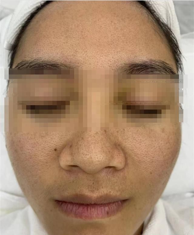 南宁一女子花1.5万元修复痘坑，睡一觉又恢复原状？痘院士：已达到效果
