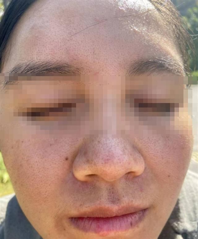 南宁一女子花1.5万元修复痘坑，睡一觉又恢复原状？痘院士：已达到效果