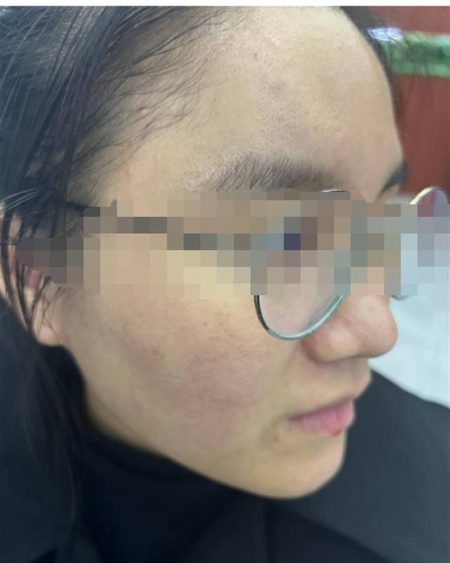 南宁一女子花1.5万元修复痘坑，睡一觉又恢复原状？痘院士：已达到效果