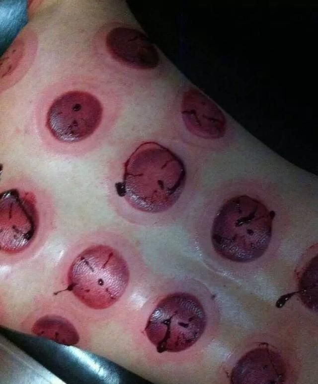 拔火罐对身体有什么作用(拔火罐对身体有什么好处吗)图6
