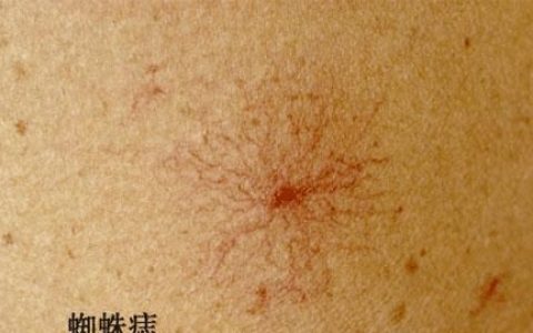 身上有红色蜘蛛痣一定是肝病吗