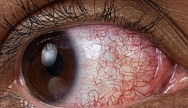眼睛经常布满红血丝，是怎么回事？