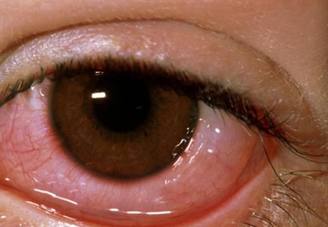 眼睛经常布满红血丝，是怎么回事？