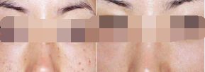 你能分清自己脸上到底什么斑吗？激光多久能改善