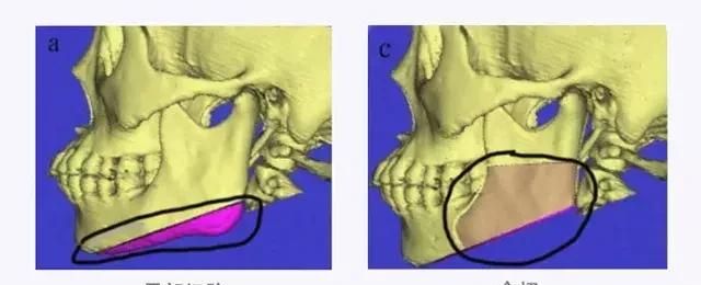 做了削骨手术都会导致脸垮吗？有更好的变美方法吗？专家讲出实话
