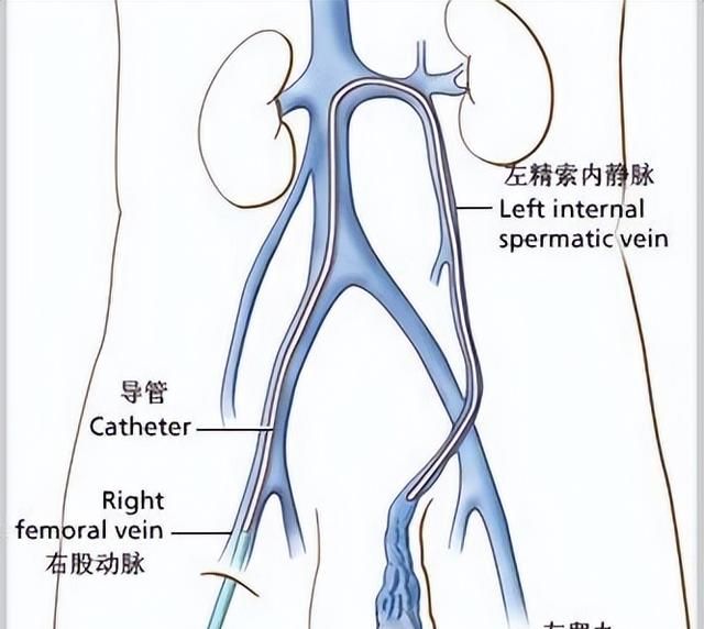 导致男性“不育”最常见的祸根，原来是精索静脉曲张，一文读懂