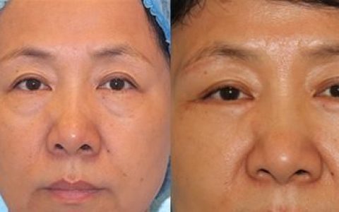 眼袋手术失败后怎么才能修复成功