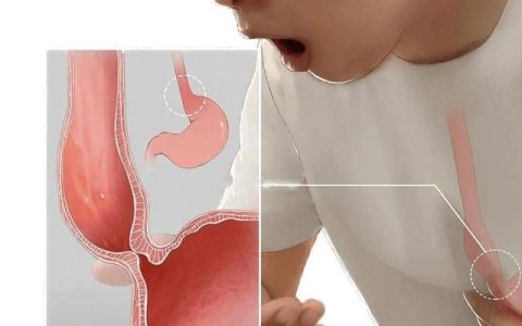 贲门失弛缓症是怎么回事?与食管癌有什么关系