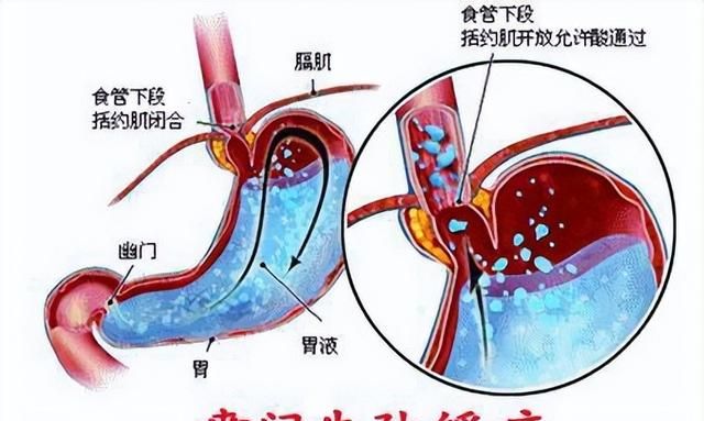 贲门失弛缓症是怎么回事？与食管癌有什么关系？