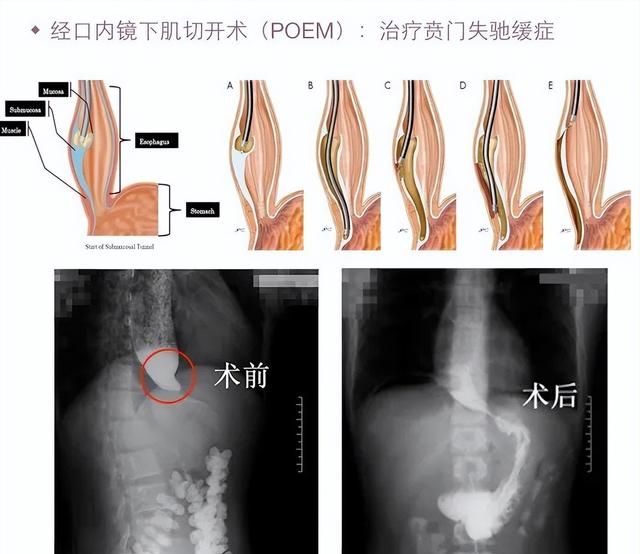 贲门失弛缓症是怎么回事？与食管癌有什么关系？