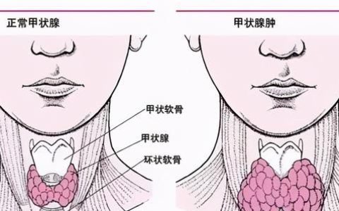 一个动作自测甲状腺疾病
